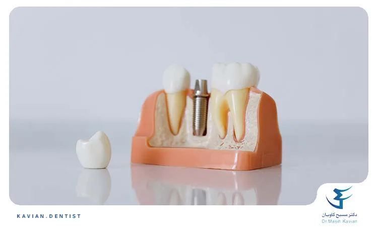 اجزای ایمپلنت دندان